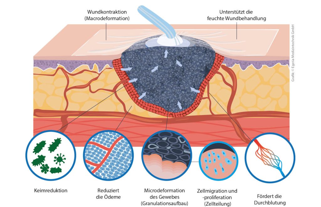 Unterdruck-Wundtherapie (NPWT) erklärt